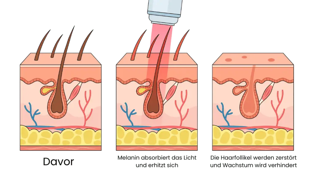 Laser Haarentfernung_Funktion
