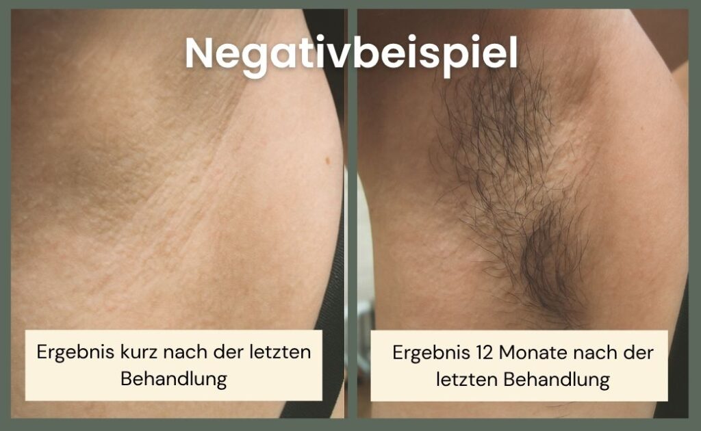 Negativbeispiel_Laser Haarentfernung Schlechte Behandlungsergebnisse_Final