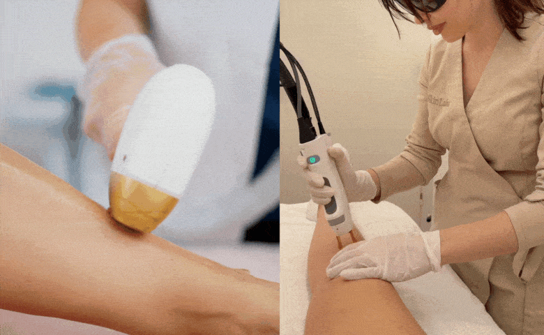 Vergleich_Laserbehandlungen